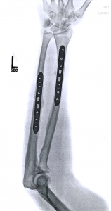 Unfortunately the new hardware did not come with superpowers: no unbreakable bones or retractable claws, only increased TSA scrutiny.